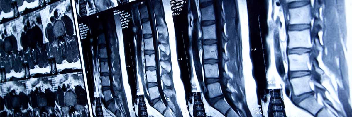 Spinal cord injury x-ray