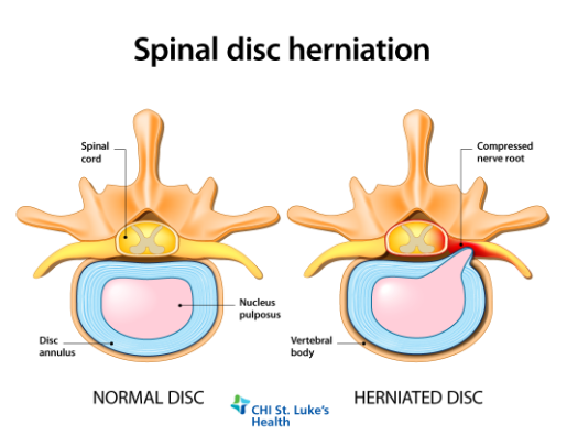 A diagram shows the difference between a healthy disc and a herniated disc.