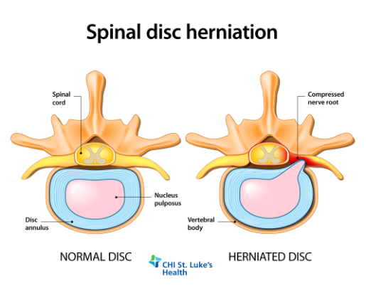 Could It Be a Herniated Disc? | St. Luke's Health A diagram shows the difference between a healthy disc and a herniated disc.