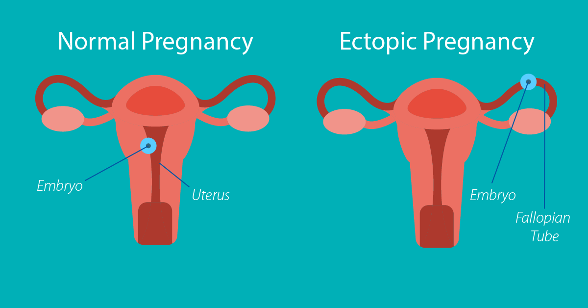 Managing an Ectopic Pregnancy 