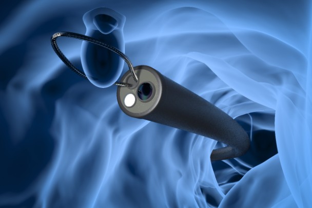 An illustration of a surgeon removing a polyp during a colonoscopy. 