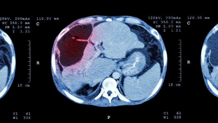 An area of a liver scan is highlighted red. 