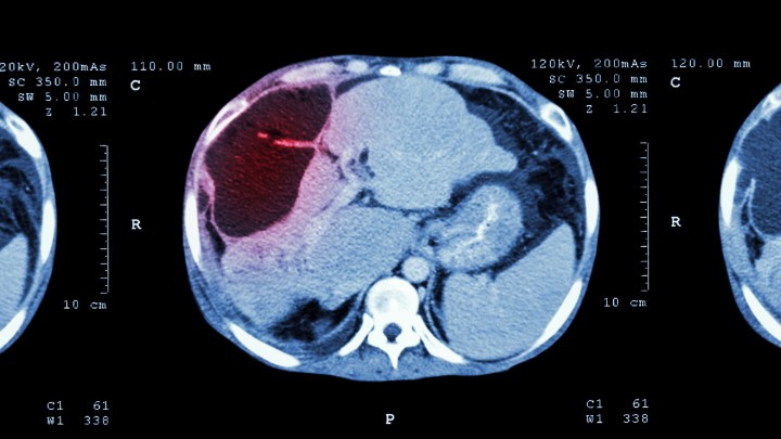 Understanding the Link Between Obesity and Liver Cancer | St. Luke's Health An area of a liver scan is highlighted red.