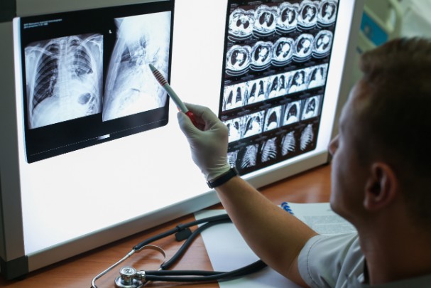 A doctor looks at x-rays of a pair of lungs. 