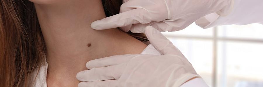 Doctor examining the neck of a woman with a mole