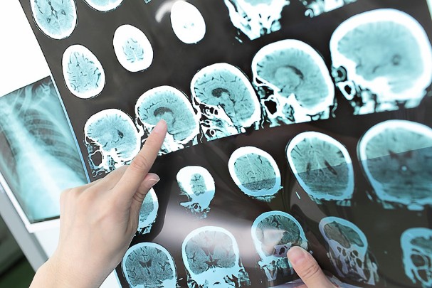 The Types of Stroke | St. Luke's Health