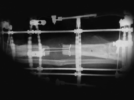 X-ray of an external fixator with a cable-pulley system for limb reconstruction. 